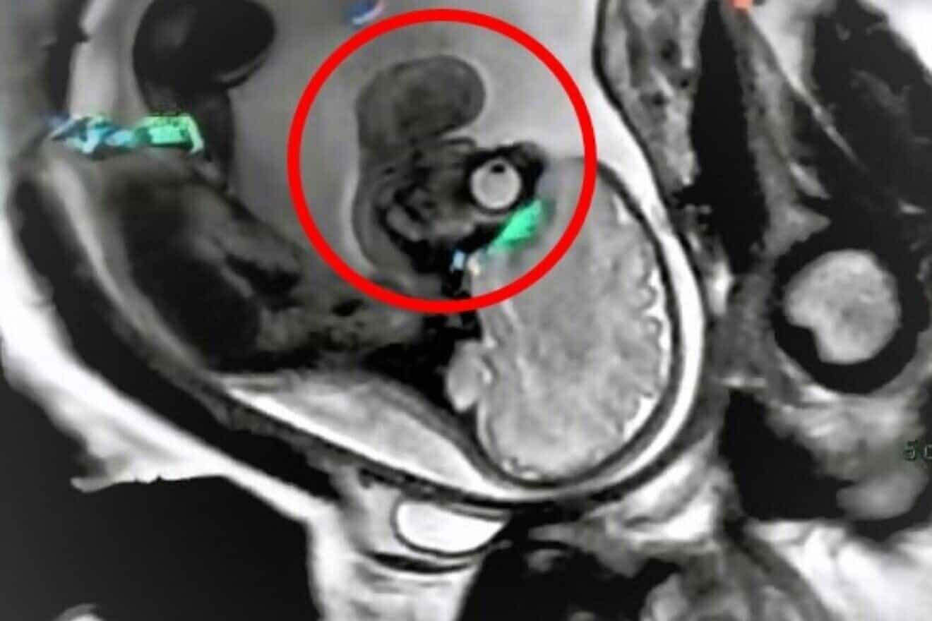 Israeli baby undergoes surgery to remove record-size facial tumor